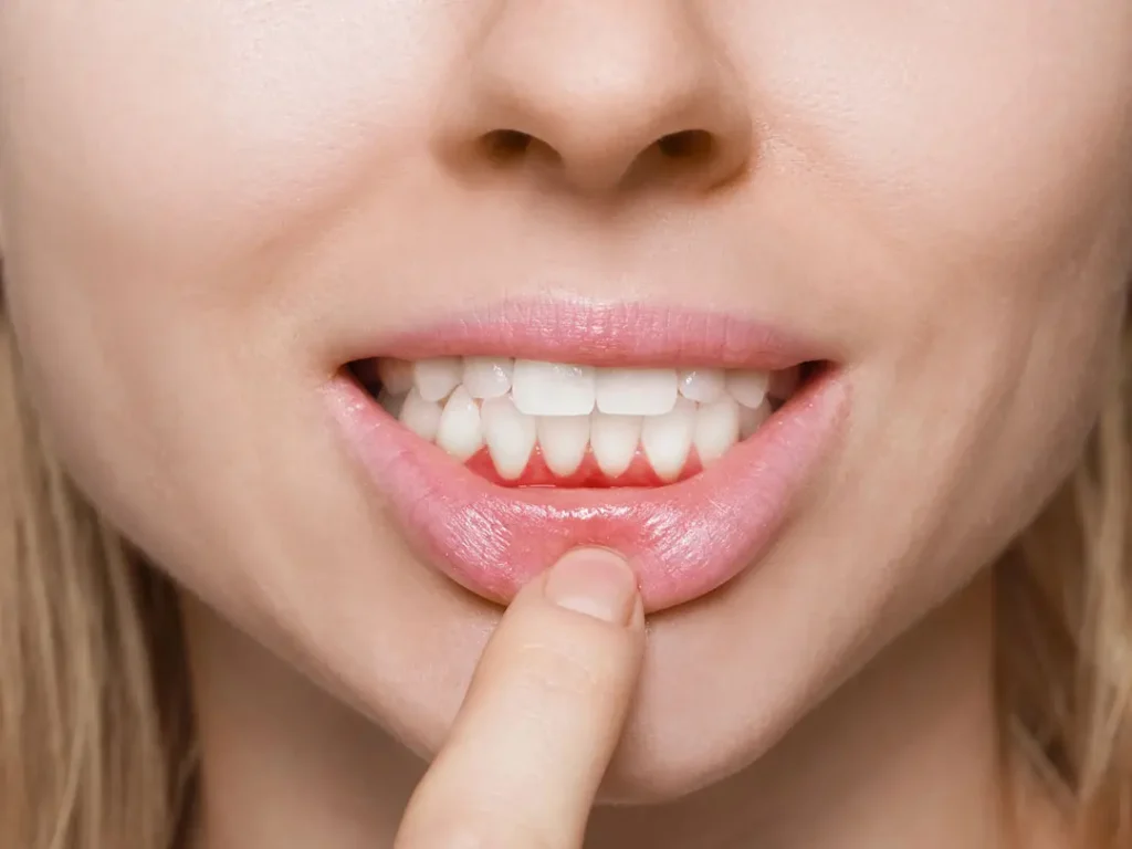 Gum Disease and Bone Loss: What Every Patient Should Know Before It Is Too Late Gum Disease and Bone Loss Explained