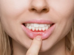 Gum Disease and Bone Loss: What Every Patient Should Know Before It Is Too Late